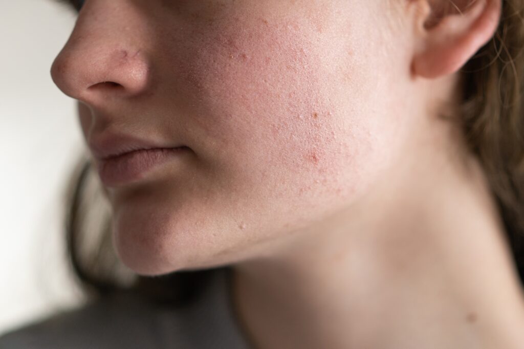 Problem skin face. A teenage girl with a troubled face.