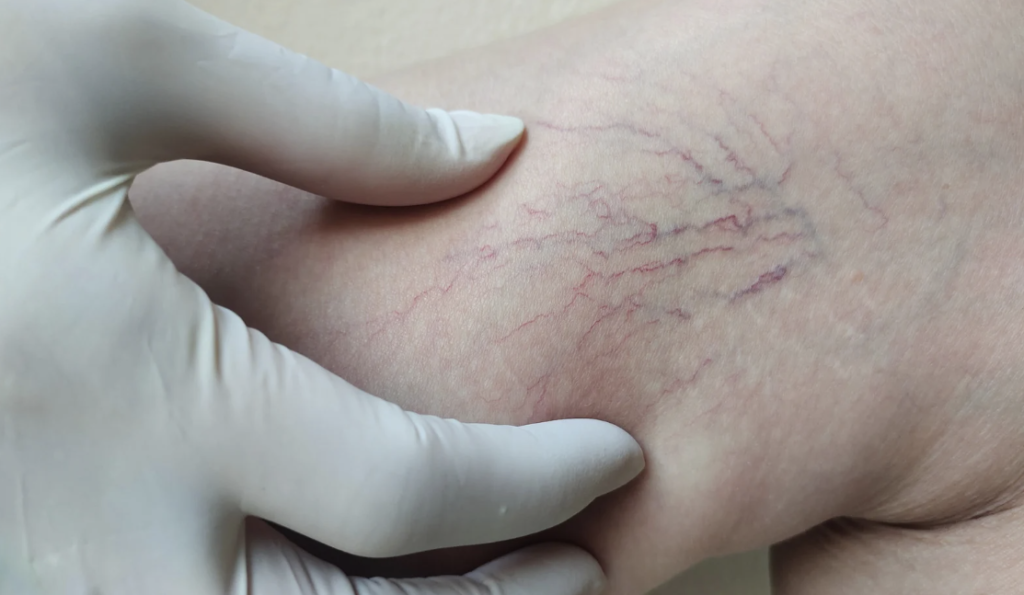 vericose vein treatment