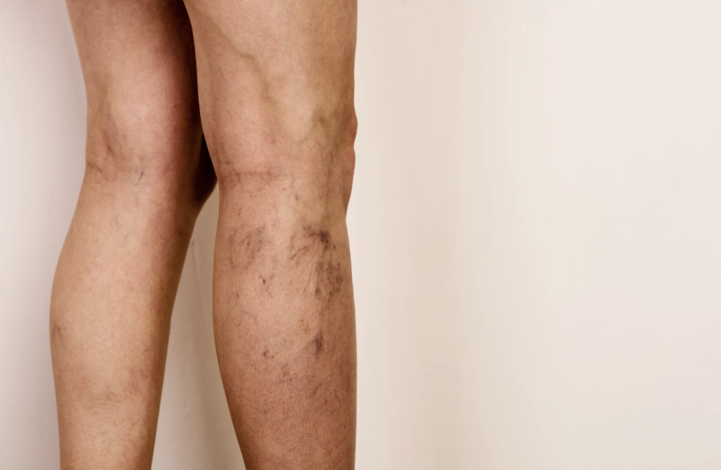 varicose vein treatment