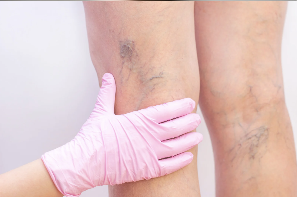 laser vein removal