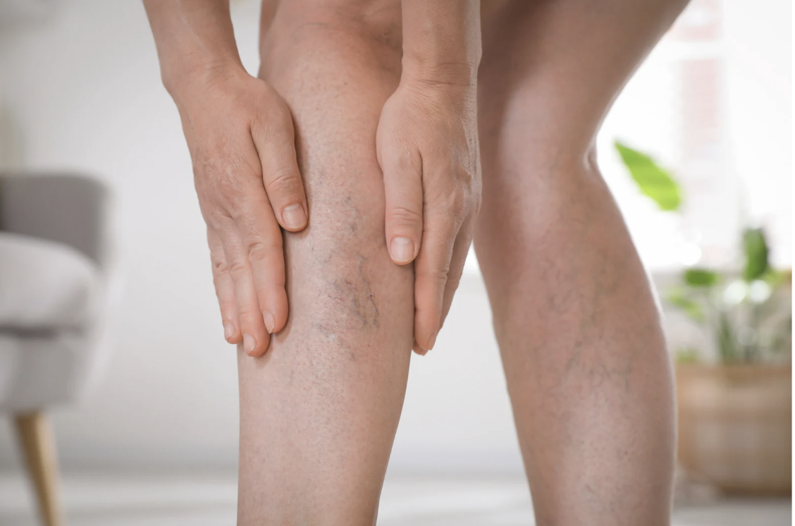 laser vein removal windermere, fl