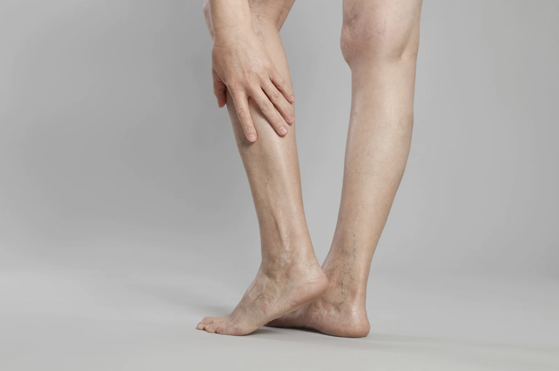 laser vein removal - what to expect