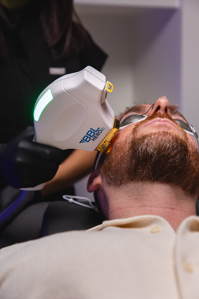 BBL HEROic treatment at Lumina Vein and Aesthetic Institute