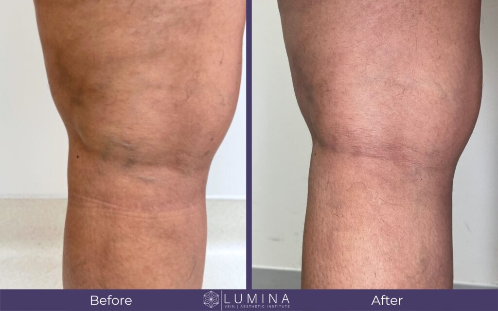 spider vein before and after dr lina vargas orlando fl (2)