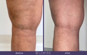 spider vein before and after dr lina vargas orlando fl (2)